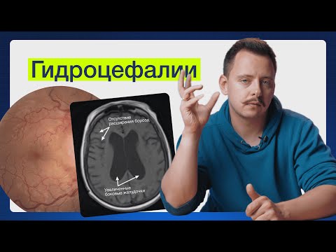 Видео: Когда лишняя жидкость угрожает мозгу?