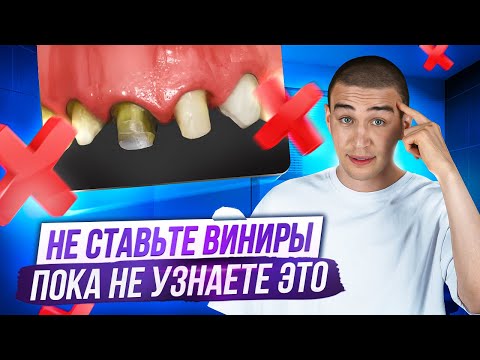 Видео: Эта ошибка при выборе ВИНИРОВ будет стоить вам зубов!