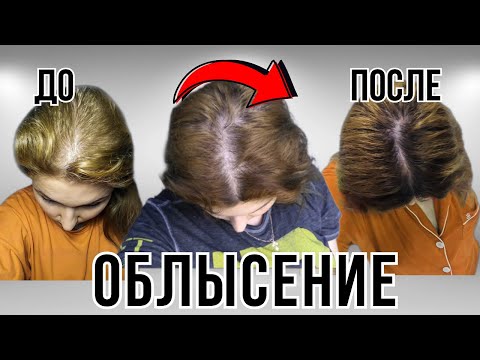 Видео: Что делать?! Выпадают волосы. АЛОПЕЦИЯ: андрогенная, диффузная...