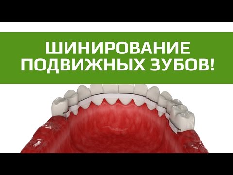 Видео: Шинирование зубов. Стекловолоконное шинирование зубов.