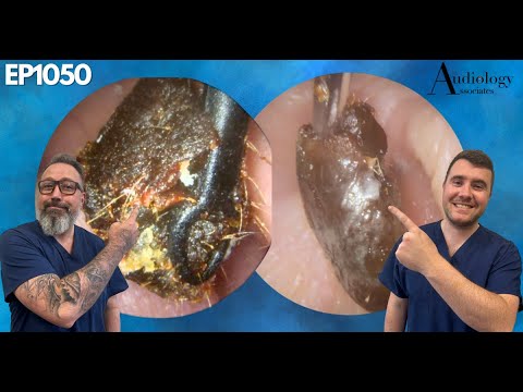 Видео: Из уха пациента удалена толстая серная пробка - EP1050