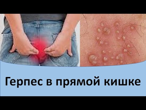 Видео: Герпес в прямой кишке