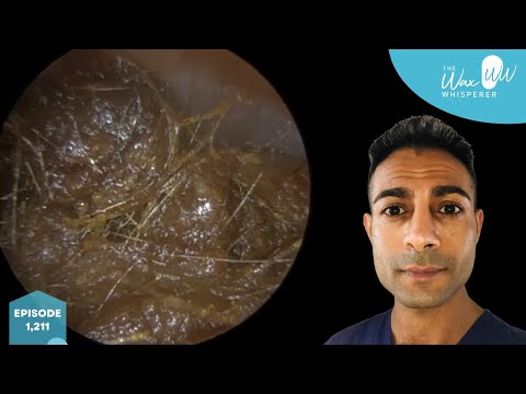 Видео: 1211 — Полное удаление ушной серы