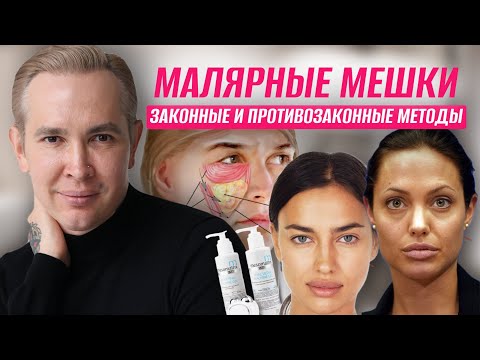Видео: Малярные мешки ЗАКОННЫЕ И ПРОТИВОЗАКОННЫЕ методы удаления  Реальное избавление от мешков под глазами