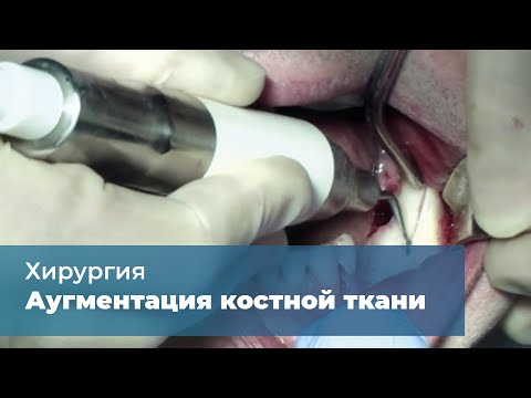 Видео: Аугментация альвеолярного отростка