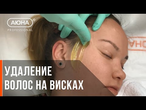 Видео: Удаление волос на висках
