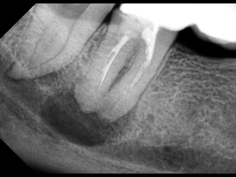 Видео: Стоит лечить зуб с "кистой" или удалять? Периодонтит. Лечение кисты зуба. Имплант. Имплантация зубов