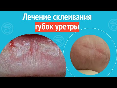 Видео: 🫦 Лечение склеивания губок уретры. Клинический случай №1398