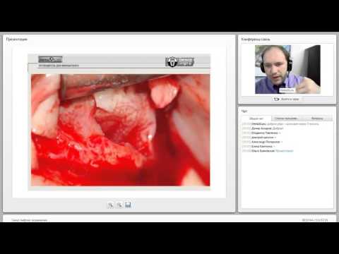 Видео: 2014 05 13 Синус лифтинг осложнения  0001