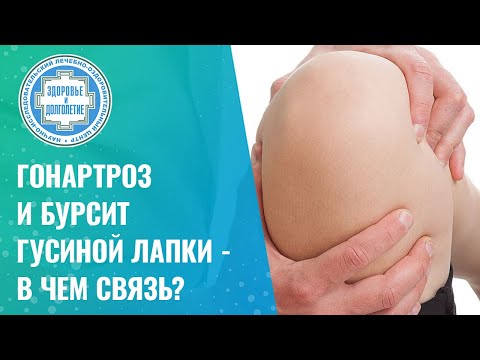 Видео: 🤷‍♂️ 🦵 Гонартроз и бурсит гусиной лапки - в чем связь?