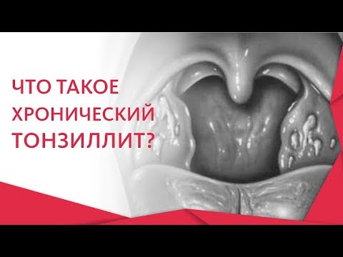 Видео: 👏 Эффективные методы лечения хронического тонизиллита. Хронический тонзиллит лечение. 12+