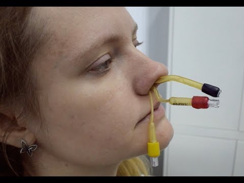 Видео: Лечение гайморита  без прокола. Ямик - процедура - безболезненный метод лечения гайморита.