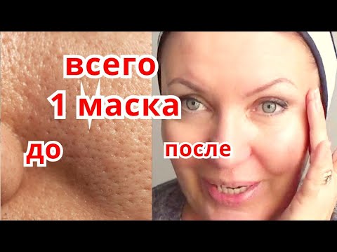 Видео: СИЛЬНЕЙШАЯ Маска для Сужения Пор !Уход за Кожей с Расширенными Порами от Морщин Рецепт