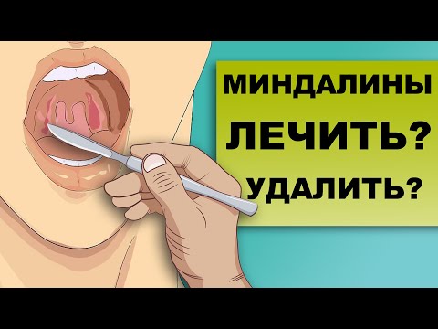 Видео: ОПАСНОСТЬ УДАЛЕНИЯ МИНДАЛИН. Зачем нам нужны гланды?