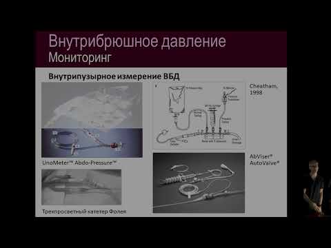 Видео: Синдром абдоминального компартмента
