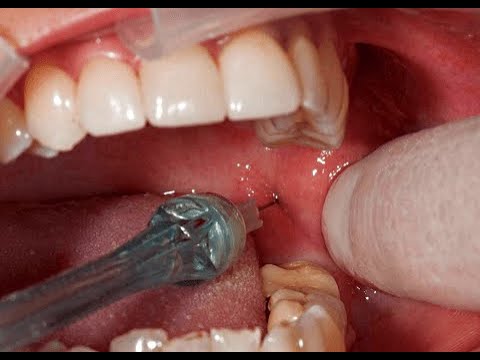 Видео: Обезболивание в хирургической стоматологии. Классификация методов обезболивания. Лекция 4 ПиМ 2 курс