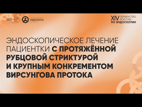 Видео: Эндоскопическое лечение пациентки с протяжённой рубцовой стриктурой, конкрементом Вирсунгова протока