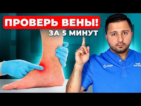 Видео: Как САМОСТОЯТЕЛЬНО выявить тромбоз? 3 ПРОСТЫХ СПОСОБА