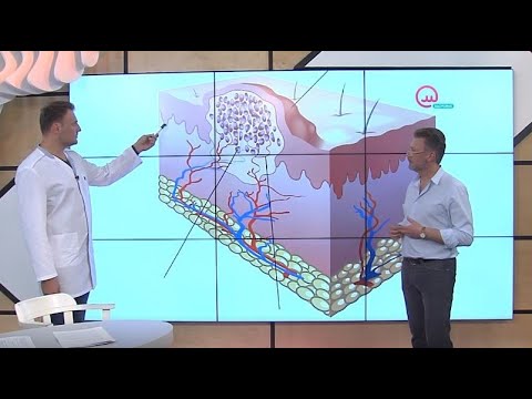 Видео: Доктор знает! Вирус папилломы человека (ВПЧ) | Телеканал "Открытый мир. Здоровье"