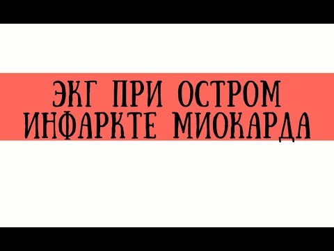 Видео: ЭКГ при инфаркте миокарда - meduniver.com