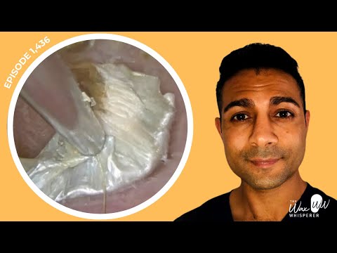 Видео: 1,436 - Очень зудящий пилинг для удаления омертвевшей кожи и кюретка Rai, используемая для удален...