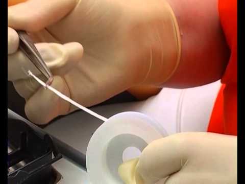 Видео: Восстановление травмированного зуба, пластика уздечек