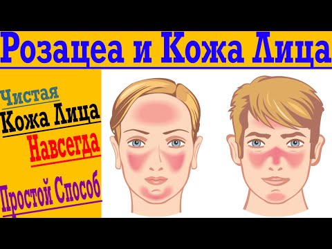 Видео: Розацеа и Чистая Кожа Лица ! Пигментные пятна на лице!