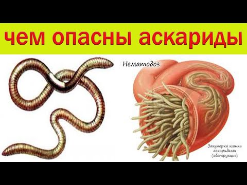 Видео: Чем опасны аскариды??? Схема лечения..