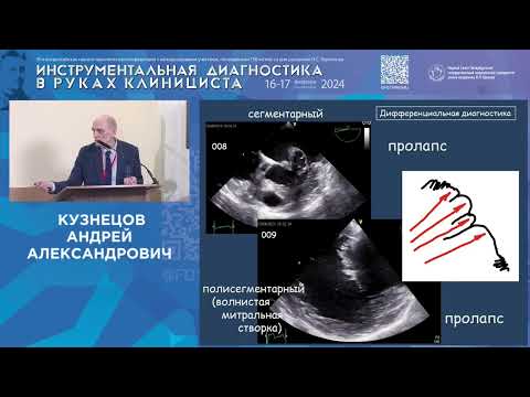 Видео: У клапанов сердца бывают аневризмы