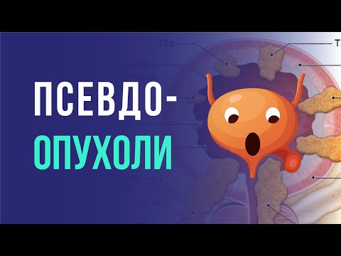 Видео: Нет это не опухоль! А что если да? Часть первая. Топ 5 псевдоопухолей мочевого пузыря