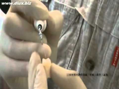 Видео: Ультразвуковой скалер в стоматологии.Часть №4