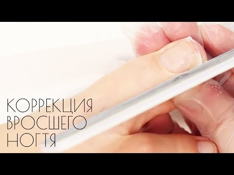 Видео: Коррекция вросшего ногтя