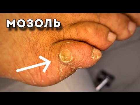 Видео: Удаляю МОЗОЛЬ полностью, но растет снова