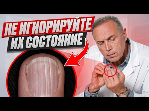 Видео: Болезни, которые видно ПО НОГТЯМ раньше, чем по анализам - проверьте себя