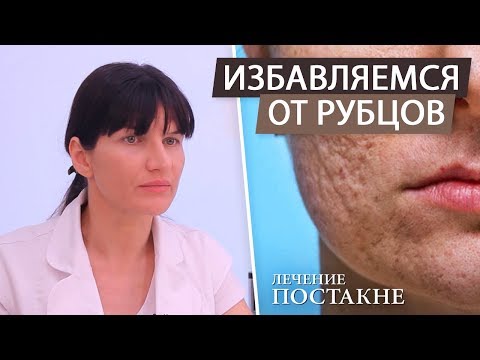 Видео: Как удалить шрамы и рубцы на лице после акне (постакне). Лазерная шлифовка после угрей и прыщей