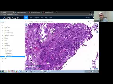 Видео: 6. Уротелиальная инвазивная карцинома
