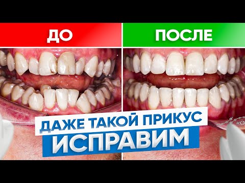 Видео: Даже из таких кривых зубов можно сделать идеальный прикус. Брекеты ДО и ПОСЛЕ