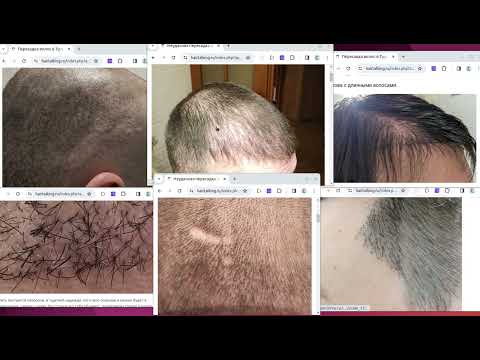 Видео: Пересадка волос в Турции. Как заманивают и уродуют. На примере блогера Красавчик.
