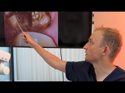 Видео: Одномоментное атравматичное удаление зуба с кистой с последующим синус-лифтингом и имплантацией