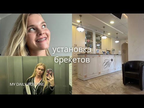 Видео: vlog: я установила брекеты