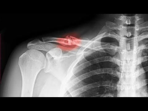 Видео: Перелом ключицы со смещением.