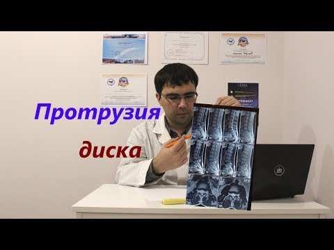 Видео: Протрузия диска: что это такое, как лечить протрузию?