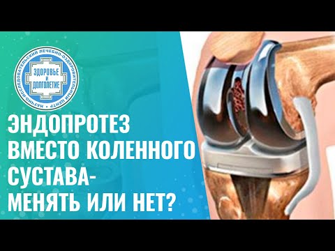Видео: 🦿 Эндопротез коленного сустава - менять или нет?