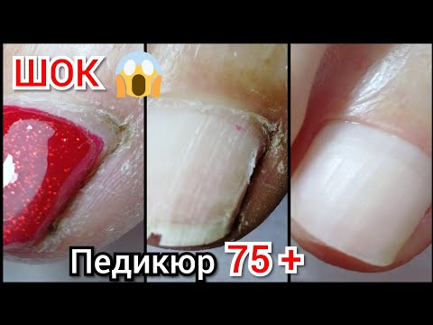 Видео: ШОК😱/ПЕДИКЮР 7️⃣5️⃣+❤️/много СУХОЙ кожи/очень ПРИЛИПШАЯ КУТИКУЛА😬/комбинированная обработка🤓