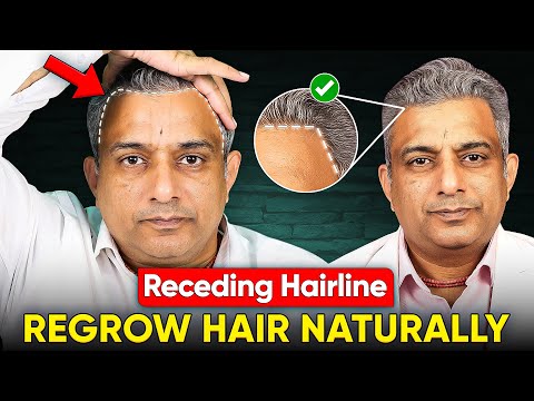 Видео: Залысины — облысение по мужскому типу, выпадение волос, истончение волос, снижение линии роста во...