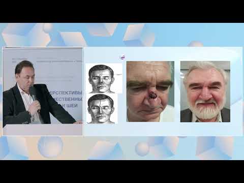 Видео: Современный подход в лечении больных местно-распространенным базальноклеточным раком. - Поляков А П