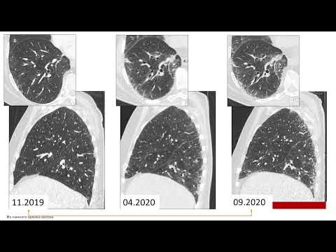 Видео: Как оценить прогрессирование фиброза по ВРКТ? Тюрин И.Е.