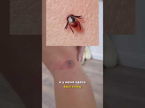 Видео: Ещё утром моя нога не была такой 😭😭😭, что делать? Я переживаю, посоветуйте 🙏