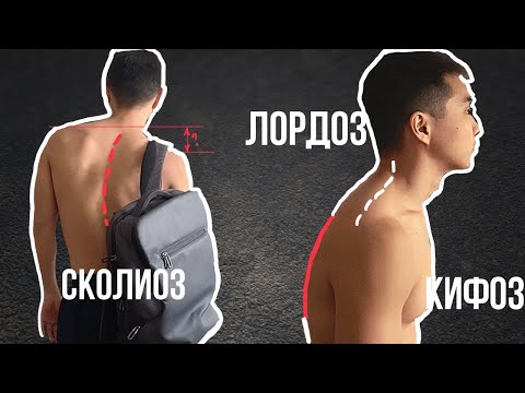 Видео: У меня был абсолютно кривой позвоночник (часть 2) | Кифоз, Лордоз, Сколиоз