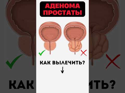 Видео: АДЕНОМА ПРОСТАТЫ 👉 Решение проблемы ДГПЖ #меднавигатор #аденома #простата